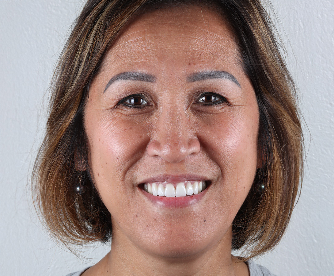 Stunning Smiles | All-on-6 reg Dental Implants, Restorative Dentistry and Dental Implants