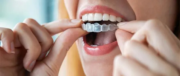 Las Vegas Invisalign